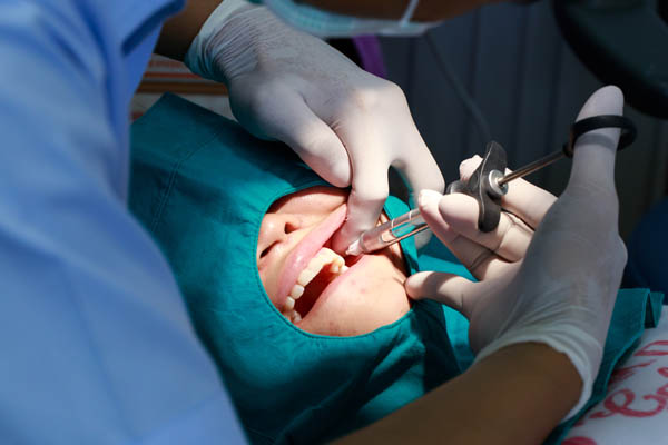 What Is An Apicoectomy Procedure?