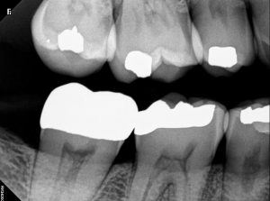 Bitewing X-rays for Root Canal Treatment