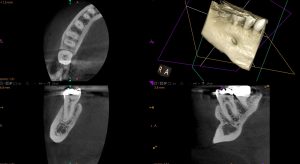 CBCT X-rays for Root Canal Treatment
