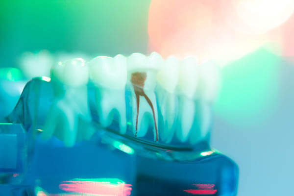 Endodontists Specialize In Treating Dental Trauma Such As A Tooth Fracture
