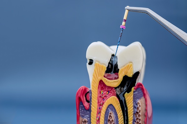 What An Endodontist Does For A Severe Tooth Abscess