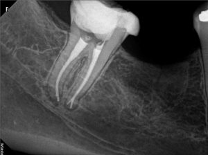 Cigna PPO Endodontist Completed Root Canal