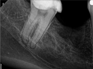 Cigna PPO Endodontist Treating #31