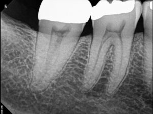 Periapical X-rays for Root Canal Treatment