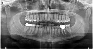 Panoramic X-rays for Root Canal Treatment