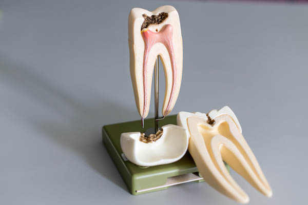 What Is An Emergency Root Canal?