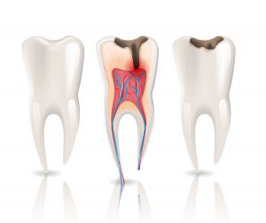 6 Signs That You May Need a Root Canal Poster