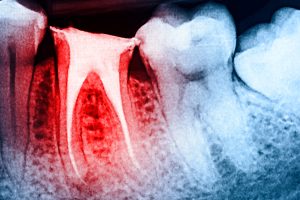 Can I Still Have Pain After a Root Canal